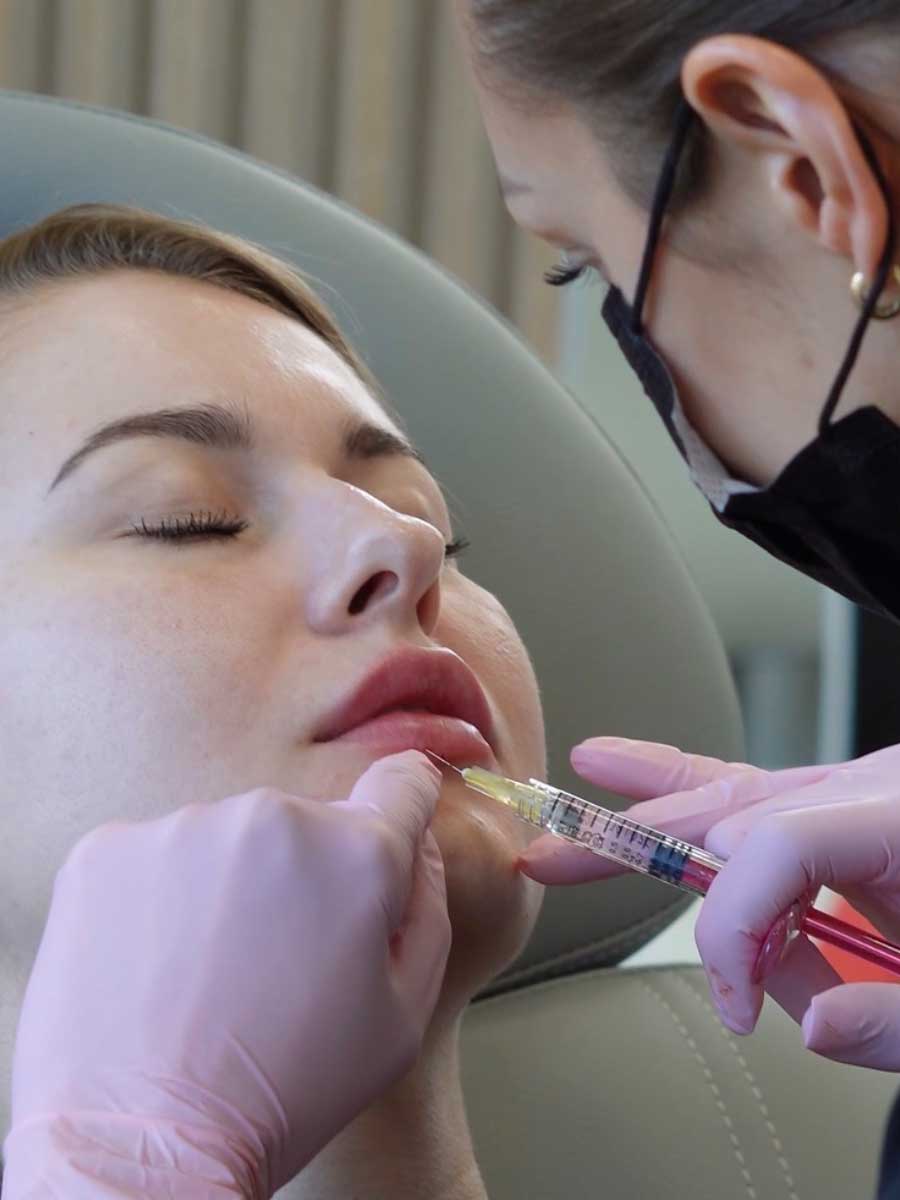 Podanie kwasu hialuronowego w usta cienką igłą